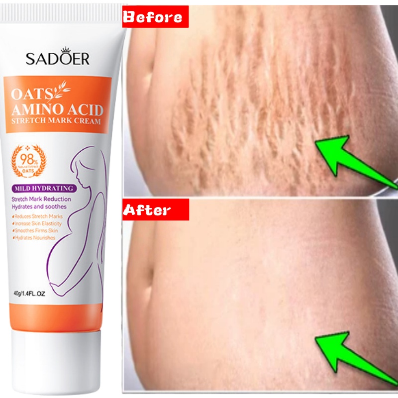 Stretch Marks Permanent Remova - Skincare Oat 评论和价格