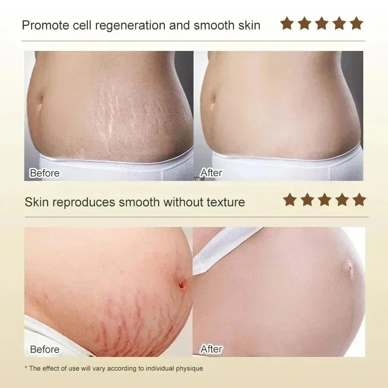 Stretch Marks Permanent Remova - Skincare Oat 评论和价格